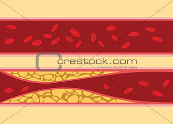 comparison between normal and unhealthy cholesterol human blood vein cell stream flow with fat on side with flat style illustration